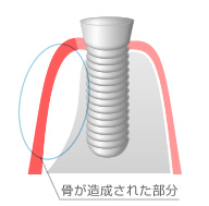 骨を再生させてインプラント治療を可能に