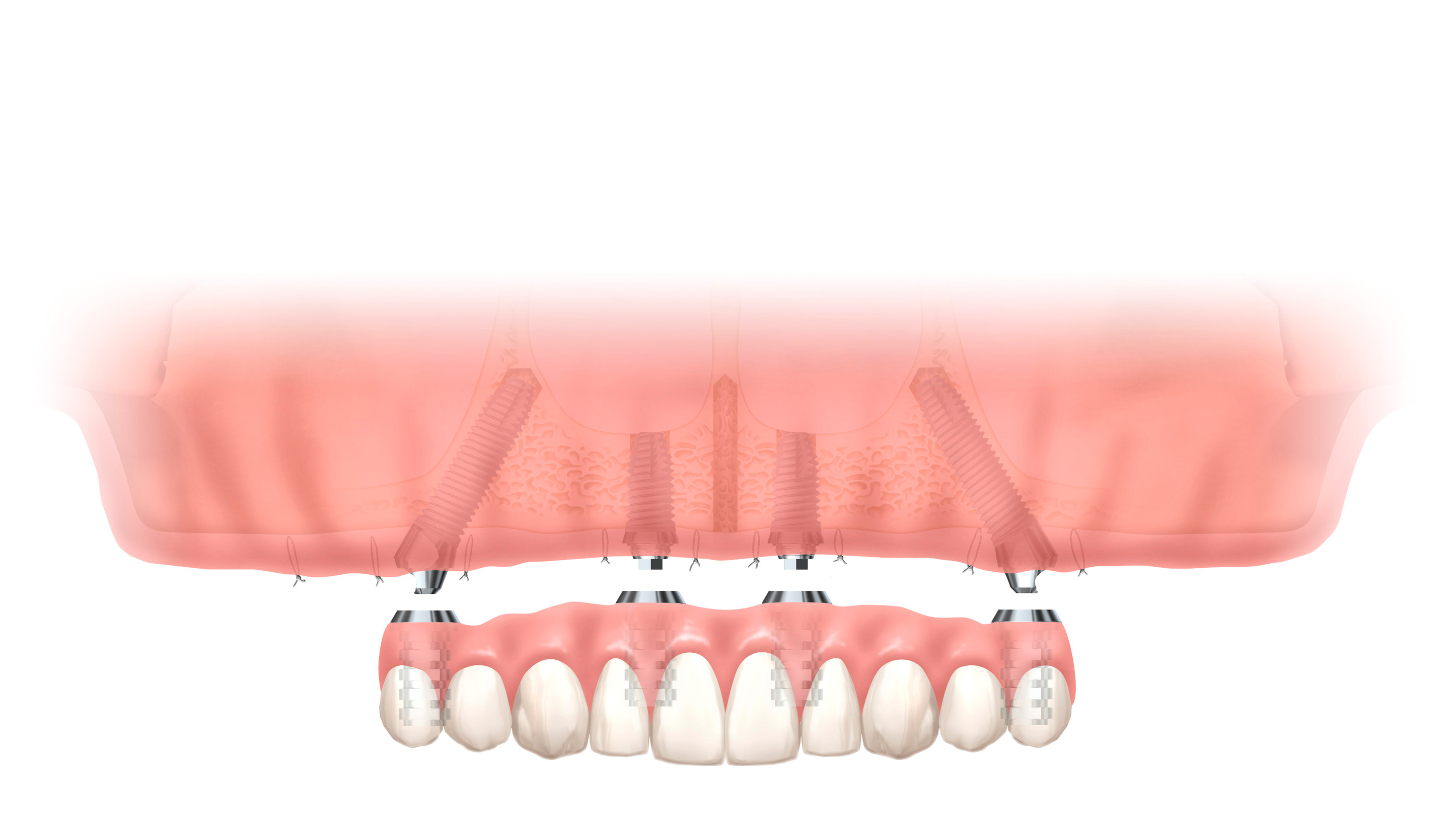 多くのインプラントを埋め込むことなく、すべての人工歯を支える治療
